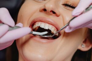 Appareils Fonctionnels Orthodontie | Enfants 8-14 ans