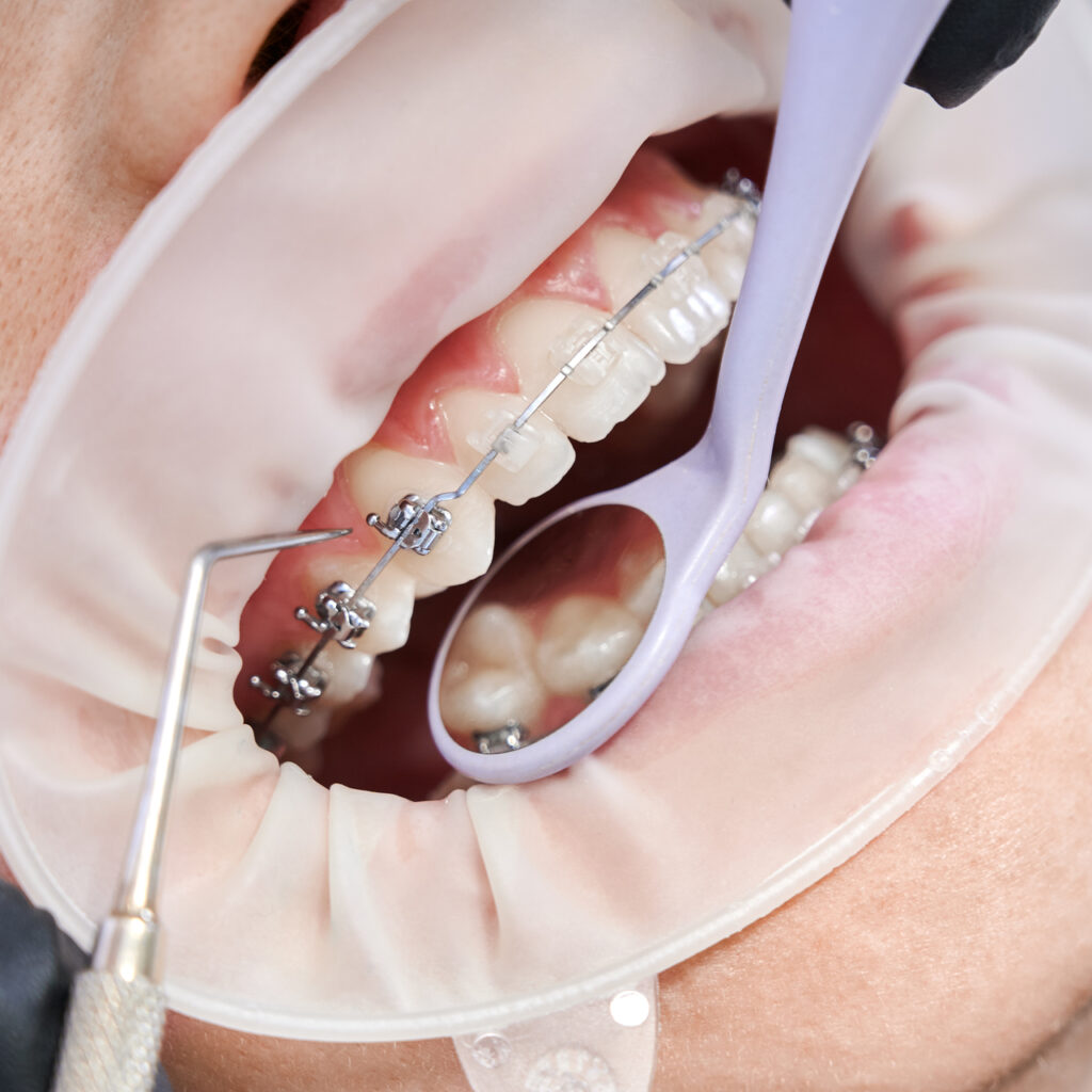 Mini-Vis Orthodontiques